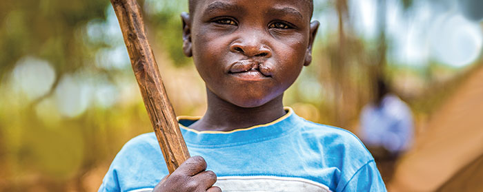 a boy with a cleft lip holding a stick